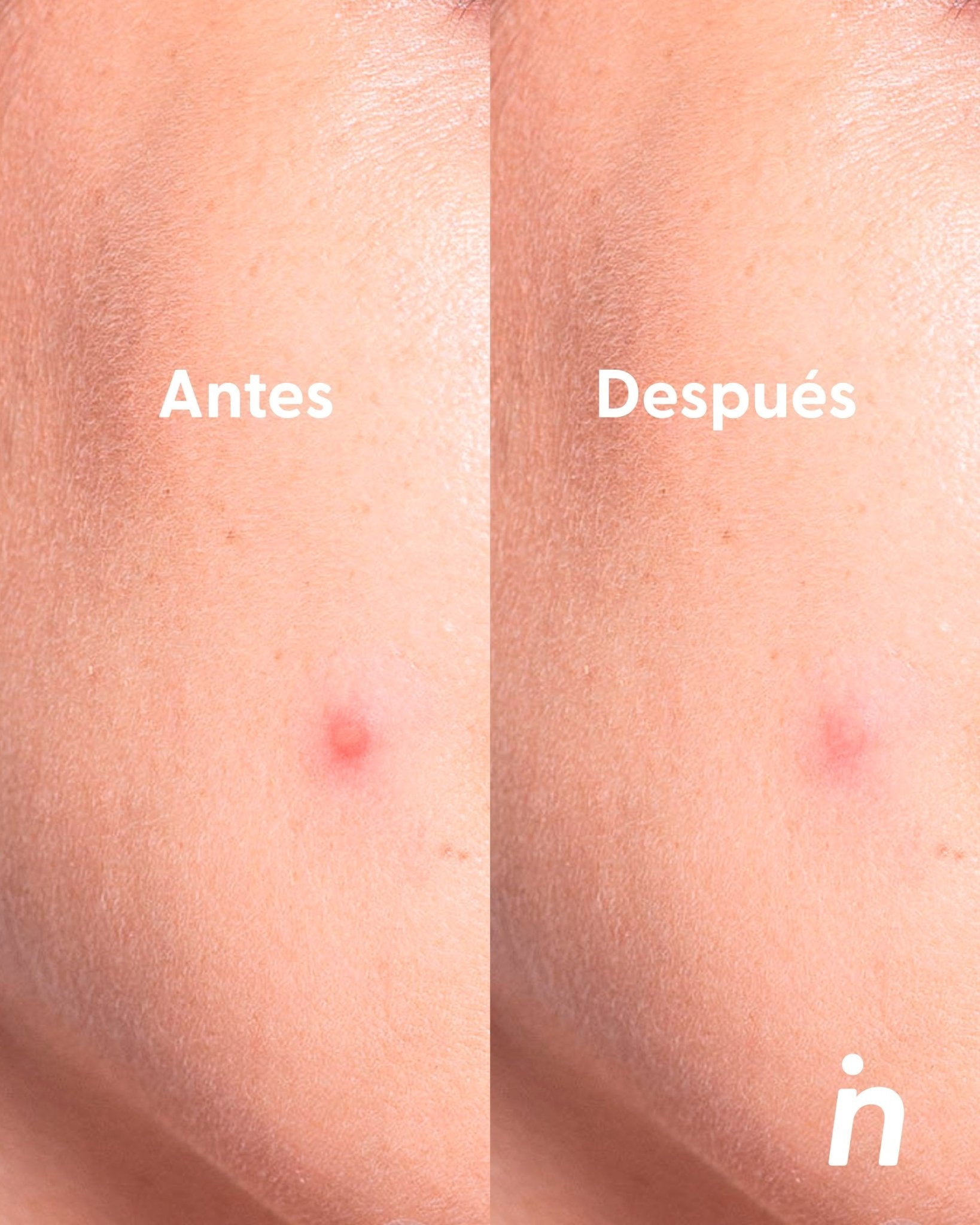 Parches con Ácido Salicílico más Estuche - Nipskin®