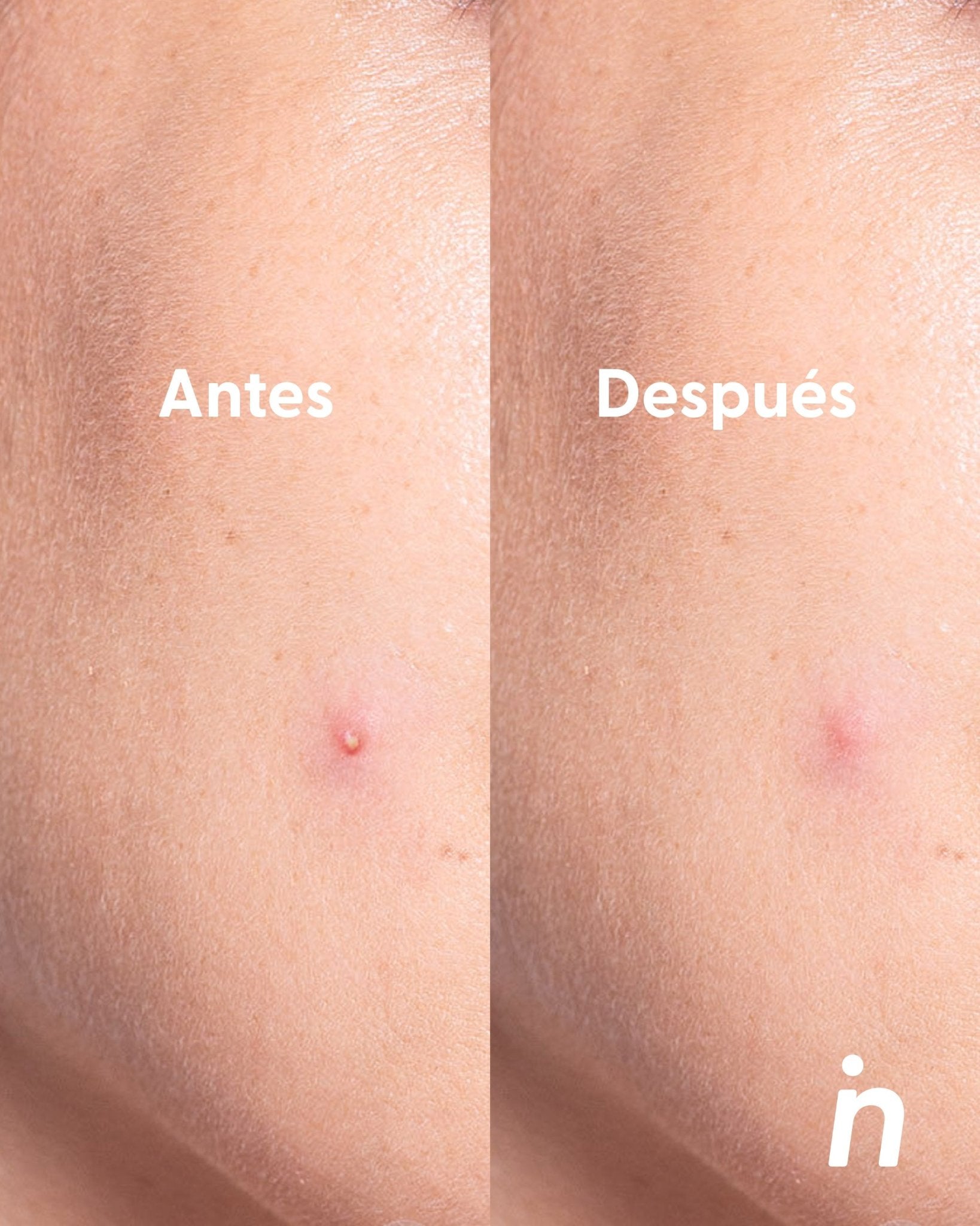 Parches para Granos más Estuche - Nipskin®
